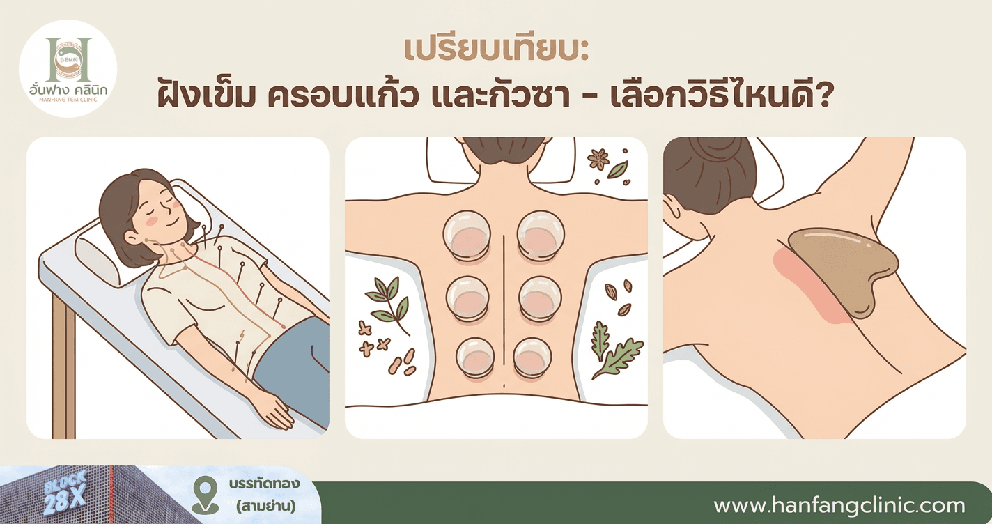 เปรียบเทียบ: ฝังเข็ม ครอบแก้ว และกัวซา - เลือกวิธีไหนดี?